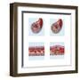 Normal Artery Compared to Plaque and Thrombus Formation in Artery-null-Framed Art Print