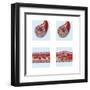 Normal Artery Compared to Plaque and Thrombus Formation in Artery-null-Framed Art Print