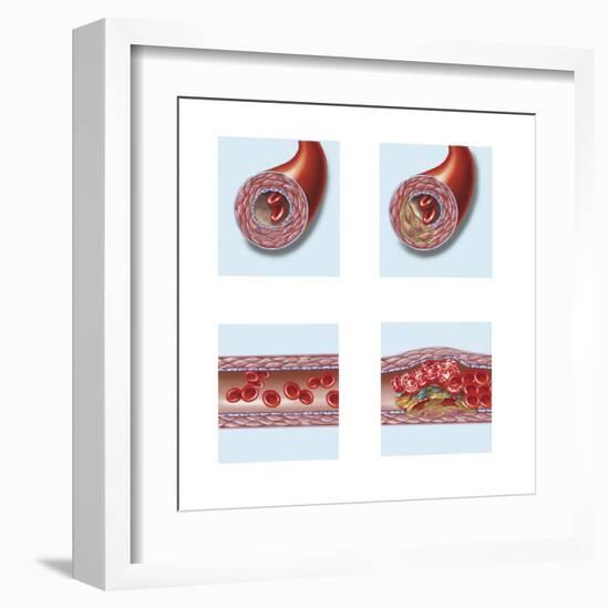 Normal Artery Compared to Plaque and Thrombus Formation in Artery-null-Framed Art Print