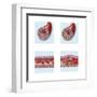 Normal Artery Compared to Plaque and Thrombus Formation in Artery-null-Framed Art Print