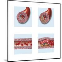Normal Artery Compared to Plaque and Thrombus Formation in Artery-null-Mounted Art Print