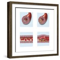 Normal Artery Compared to Plaque and Thrombus Formation in Artery-null-Framed Art Print