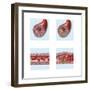 Normal Artery Compared to Plaque and Thrombus Formation in Artery-null-Framed Art Print