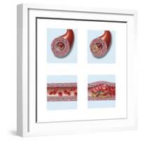 Normal Artery Compared to Plaque and Thrombus Formation in Artery-null-Framed Art Print