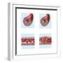 Normal Artery Compared to Plaque and Thrombus Formation in Artery-null-Framed Art Print