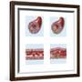 Normal Artery Compared to Plaque and Thrombus Formation in Artery-null-Framed Art Print