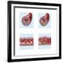 Normal Artery Compared to Plaque and Thrombus Formation in Artery-null-Framed Art Print