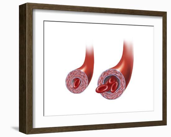 Normal Artery Versus Artery in Spasm-null-Framed Art Print