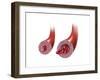 Normal Artery Versus Artery in Spasm-null-Framed Art Print