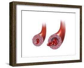 Normal Artery Versus Artery in Spasm-null-Framed Art Print