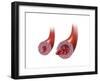 Normal Artery Versus Artery in Spasm-null-Framed Art Print