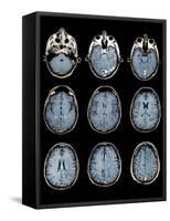 Normal Brain, MRI Scans-ZEPHYR-Framed Stretched Canvas