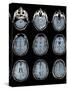 Normal Brain, MRI Scans-ZEPHYR-Stretched Canvas