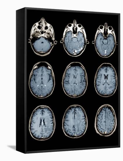 Normal Brain, MRI Scans-ZEPHYR-Framed Stretched Canvas