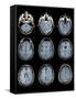 Normal Brain, MRI Scans-ZEPHYR-Framed Stretched Canvas