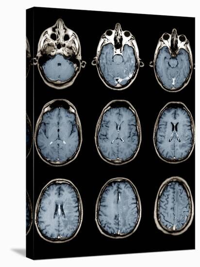 Normal Brain, MRI Scans-ZEPHYR-Stretched Canvas