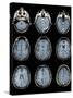 Normal Brain, MRI Scans-ZEPHYR-Stretched Canvas