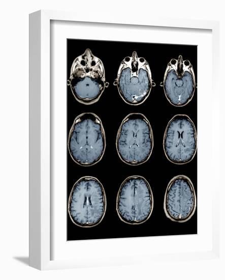 Normal Brain, MRI Scans-ZEPHYR-Framed Photographic Print