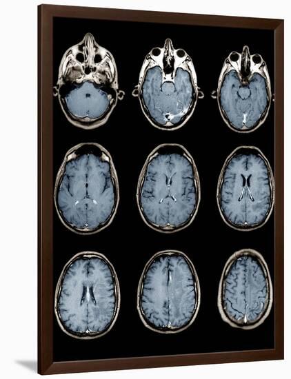 Normal Brain, MRI Scans-ZEPHYR-Framed Photographic Print