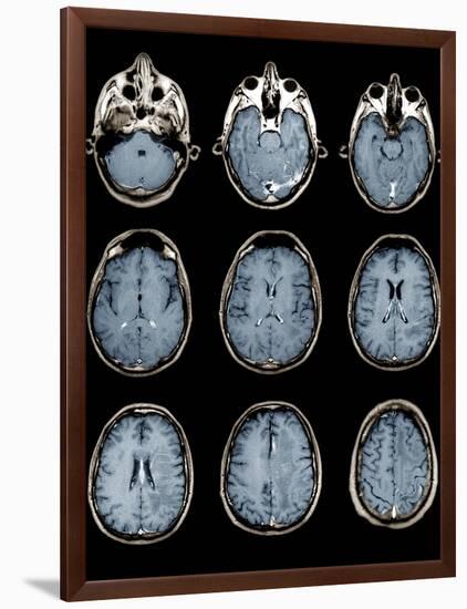 Normal Brain, MRI Scans-ZEPHYR-Framed Photographic Print