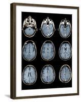 Normal Brain, MRI Scans-ZEPHYR-Framed Photographic Print