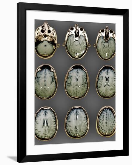 Normal Brain, MRI Scans-ZEPHYR-Framed Photographic Print