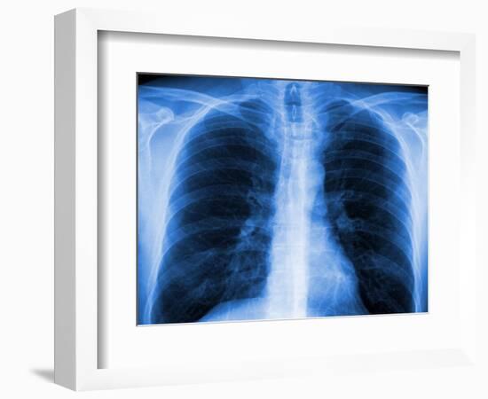 Normal Chest X-ray-PASIEKA-Framed Photographic Print