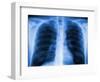 Normal Chest X-ray-PASIEKA-Framed Photographic Print