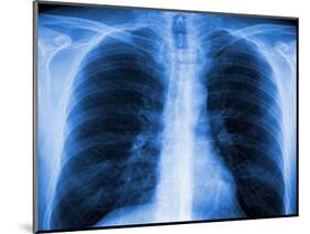 Normal Chest X-ray-PASIEKA-Mounted Photographic Print