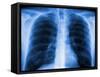 Normal Chest X-ray-PASIEKA-Framed Stretched Canvas