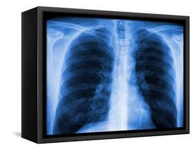 Normal Chest X-ray-PASIEKA-Framed Stretched Canvas