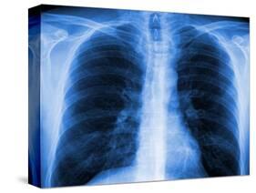 Normal Chest X-ray-PASIEKA-Stretched Canvas