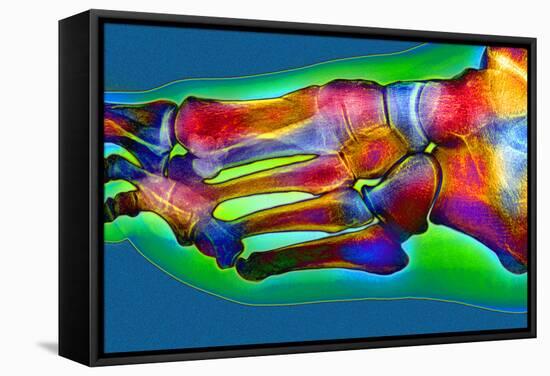 Normal Foot, X-ray-Du Cane Medical-Framed Stretched Canvas
