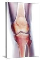 Normal Knee, X-ray-Du Cane Medical-Stretched Canvas