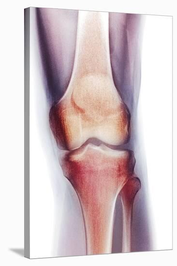 Normal Knee, X-ray-Du Cane Medical-Stretched Canvas