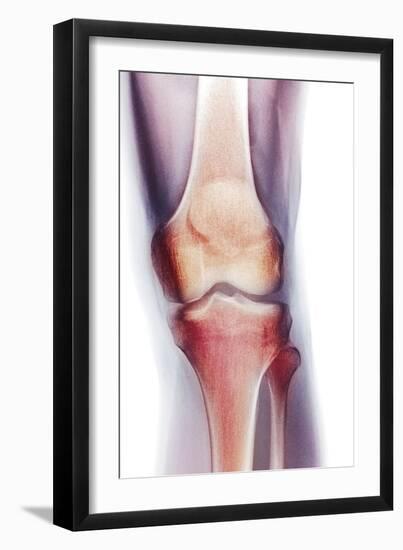 Normal Knee, X-ray-Du Cane Medical-Framed Photographic Print