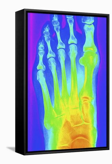 Normal Left Foot, X-ray-PASIEKA-Framed Stretched Canvas