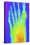 Normal Left Foot, X-ray-PASIEKA-Stretched Canvas