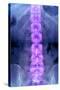Normal Lumbar Spine, X-ray-Du Cane Medical-Stretched Canvas