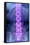 Normal Lumbar Spine, X-ray-Du Cane Medical-Framed Stretched Canvas