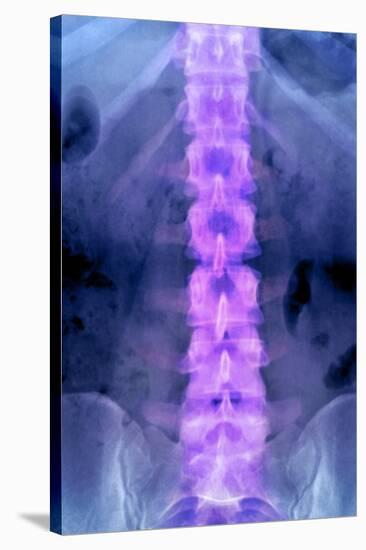 Normal Lumbar Spine, X-ray-Du Cane Medical-Stretched Canvas