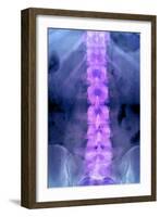 Normal Lumbar Spine, X-ray-Du Cane Medical-Framed Photographic Print