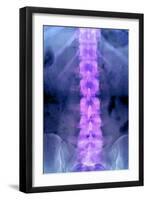 Normal Lumbar Spine, X-ray-Du Cane Medical-Framed Photographic Print