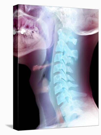 Normal Neck, X-ray-Du Cane Medical-Stretched Canvas
