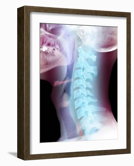 Normal Neck, X-ray-Du Cane Medical-Framed Photographic Print