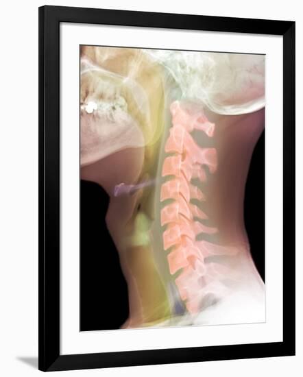 Normal Neck, X-ray-Du Cane Medical-Framed Photographic Print