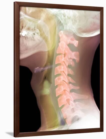 Normal Neck, X-ray-Du Cane Medical-Framed Photographic Print