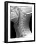 Normal Neck, X-ray-Du Cane Medical-Framed Photographic Print