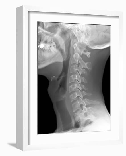 Normal Neck, X-ray-Du Cane Medical-Framed Photographic Print