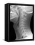 Normal Neck, X-ray-Du Cane Medical-Framed Stretched Canvas